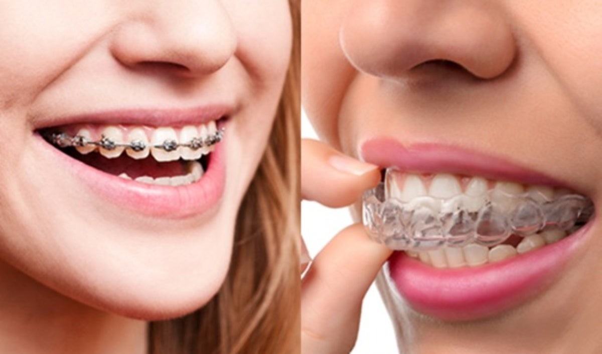 Deciding Between Clear Aligners and Traditional Braces