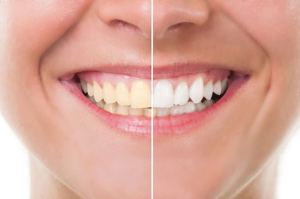 The Impact of Veneers on Confidence