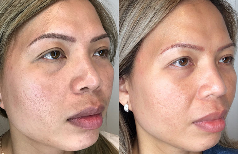 Microneedling for Wrinkle Reduction
