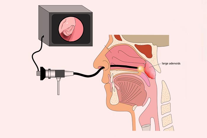 Treatment and Management Options for Nasal Polyps