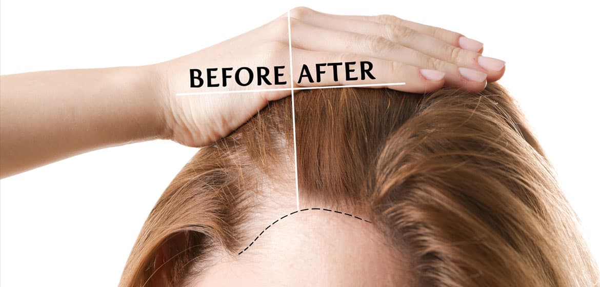 What To Know About Hair Restoration Techniques